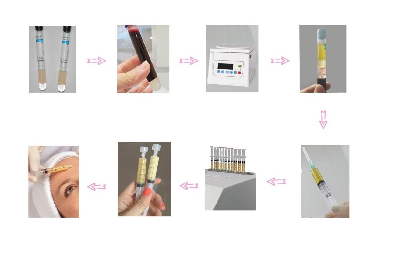 Máy làm đầy sinh học Plasma Taisite, Model: Plasma Bio-filler